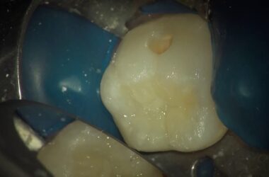 Dentsply-SDR-CeramX-One-Post-Endo-Restoration