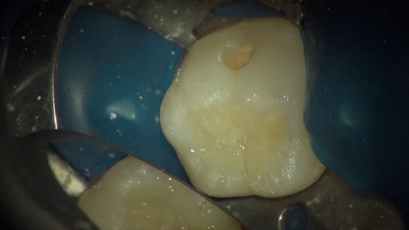 Dentsply-SDR-CeramX-One-Post-Endo-Restoration