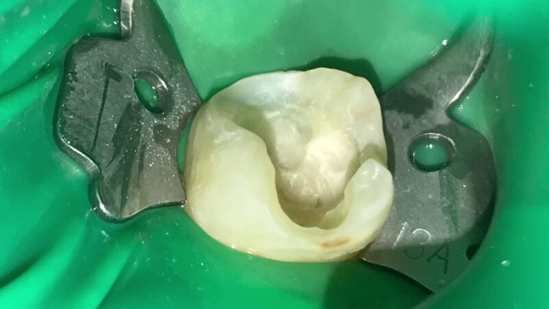 Direct-restoration-with-composite-ceram.X-by-DENTSPLY-SIRONA